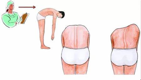 脊柱侧弯亚当测试.bmp 脊柱侧弯亚当测试.bmp