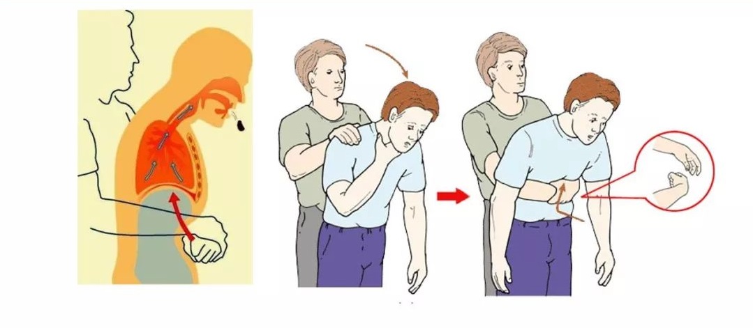 腹部冲击法_海姆立克.jpg