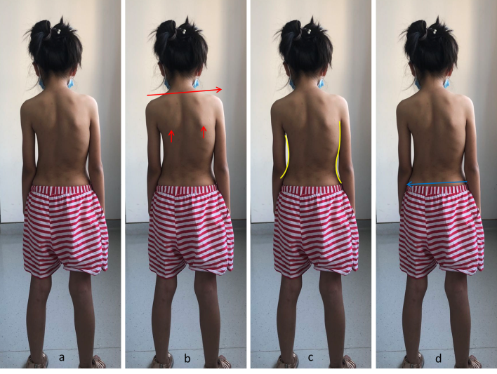 脊柱侧弯自测.png 脊柱侧弯自测.png