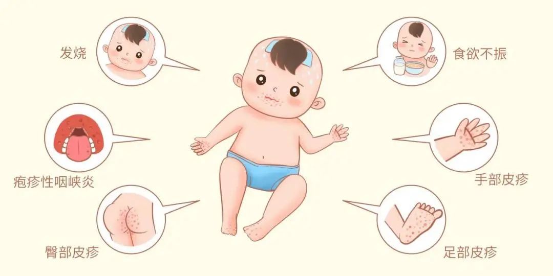 手足口病症状.jpg